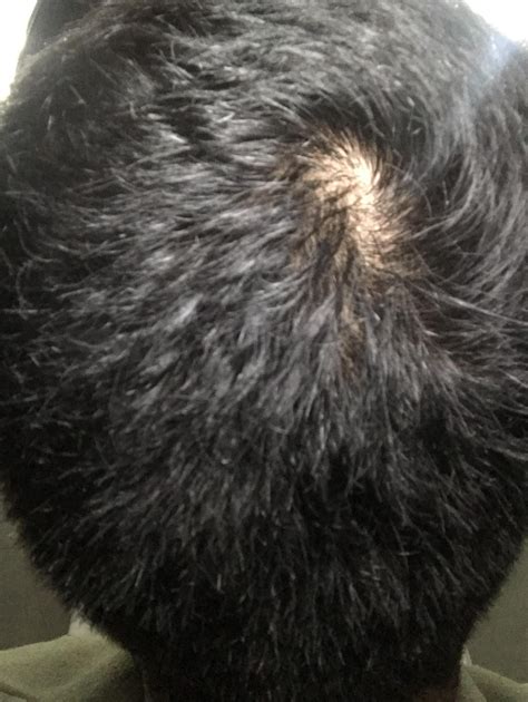 Hey Guys So Ive Been Tracking The Progress Of This Crown On My Scalp