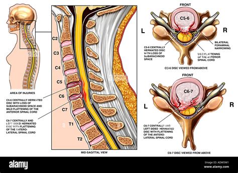 Spine Surgery C And C Disc Herniations With Spinal Cord Sexiz Pix