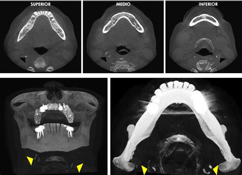 Aplicaciones De La Tomografía Para Cirugía Maxilofacial Dento Metric