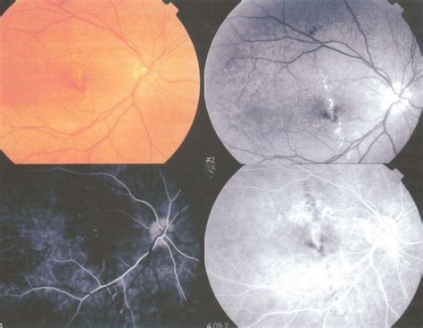 Initial Fundus Photographs Of The Right Eye With Fluorescein