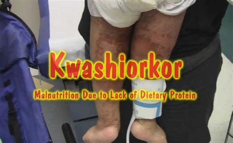 Kwashiorkor Skin Rashes