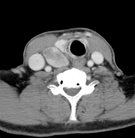 Parathyroid Adenoma Image