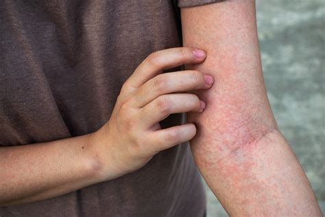 Skin Rashes That Itch On Arms Sexiz Pix