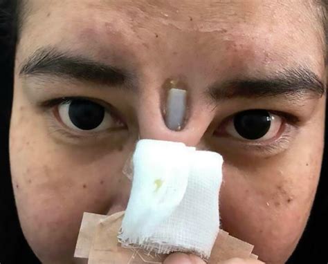 Botched Nose Job Leaves Woman With Implant Sticking Out Between Her Eyes