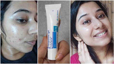 Dermatologist Recommended Best Cream To Remove Pimple Marks Dark Spots