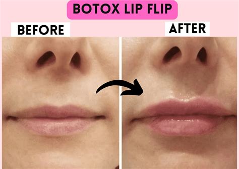 Botox Lip Flip Side Effects The Daily Glimmer