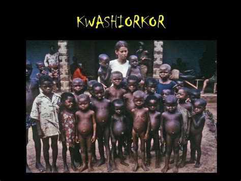 Kwashiorkor