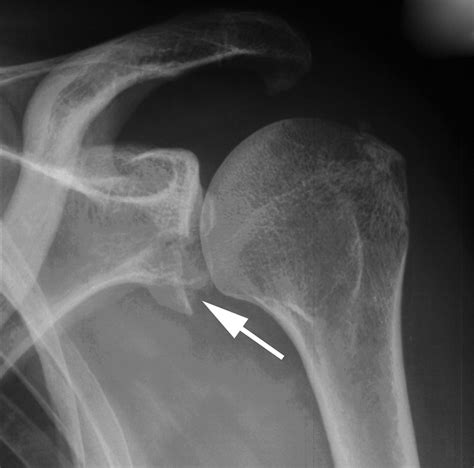 Non Operative Treatment Of Large Anterior Glenoid Rim Fractures After