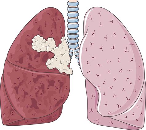 Cancer Clipart Lung Cancer Cancer Lung Cancer Transparent Free For