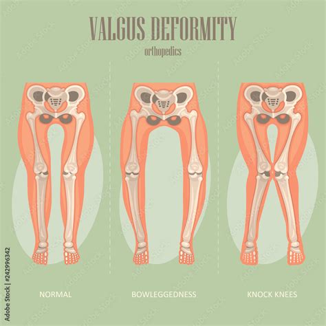 Valgus Deformity Vector Medical Poster Stock Vector Adobe Stock