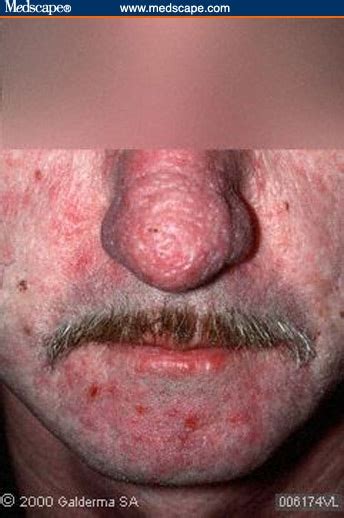 Acne And Rosacea Differential Diagnosis And Treatment In The Primary