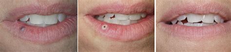 They are small—anywhere from the size of a pinhead. Birthmarks Treatment with Vascular Laser Richmond VA ...