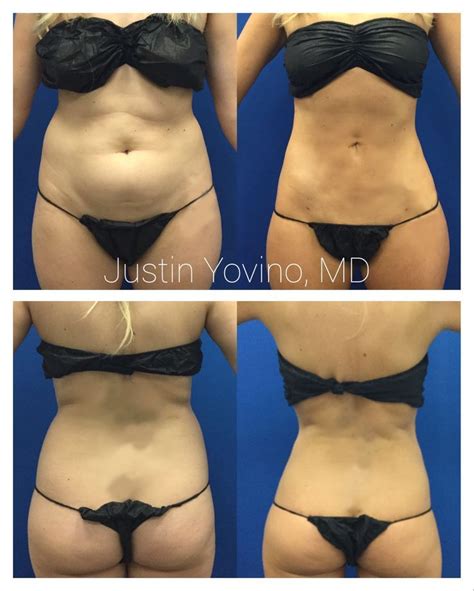 Supersculpting Liposuction Of The Abdomen Flanks Love Handles And Ta 39love