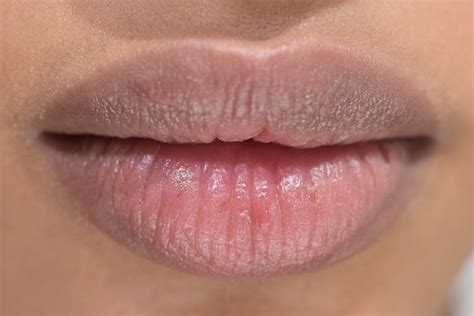 7 Ways Chapped Lips Could Be A Sign Of Something Else