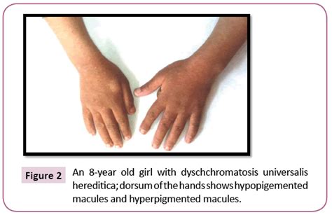 Dyschromatosis In A Child A Case Report And Differential Diagnosis