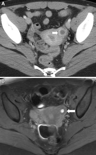 A Axial Contrast Enhanced Ct Image Of The Pelvis Of A 36 Year Old Woman