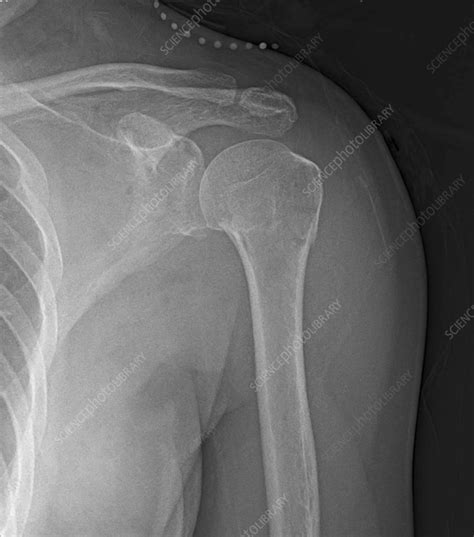 Humerus Fracture X Ray Stock Image F Science Photo Library