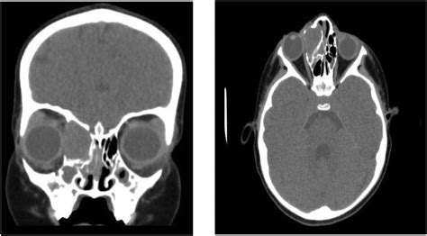 Paranasal Sinuses Computed Tomography Scan At Coronal And Axial