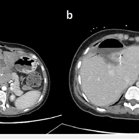 Abdominal Ct Scan Showing A A Large Heterogeneous Hypodense Irregular