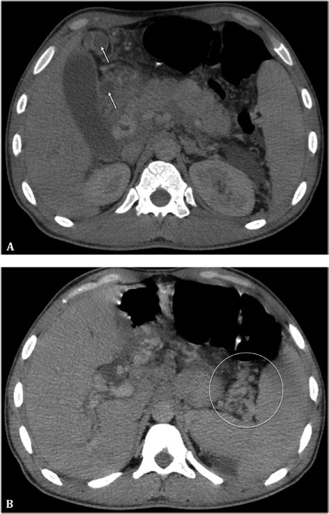 Axial Abdominal Ct Scan Images Demonstrating Enlarged Lymph Nodes With