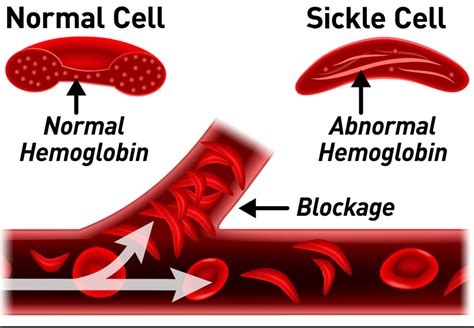 Sickle Cell Disease Diagram