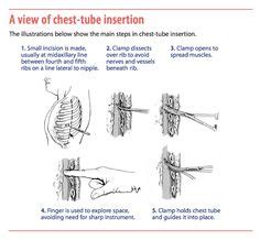 1 chest tube insertion lab. Chest tube drainage & Thoracocentesis... ( Muscle pierced ...