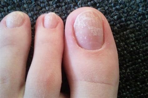 How To Remove White Spots On Nails