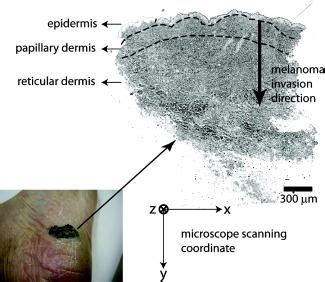 Bipolar Cellular Morphology Of Malignant Melanoma In Unstained Human Melanoma Skin Tissue