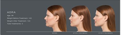 Kybella Injections For Chin Fat Reduction Dallas Plano Ft Worth