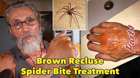Brown Recluse Spider Spider Bite