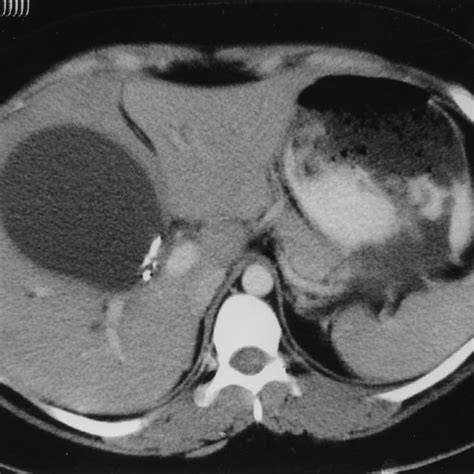 Pdf Extrahepatic Biliary Obstruction Due To Post Laparoscopic