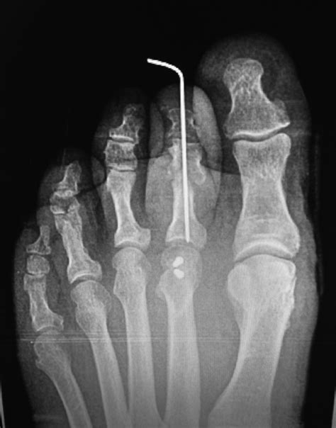Digital Arthrodesis Of The Lesser Toes Clinics In Podiatric Medicine