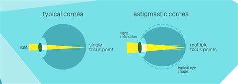 What Is Astigmatism Signs And Symptoms Vision Works