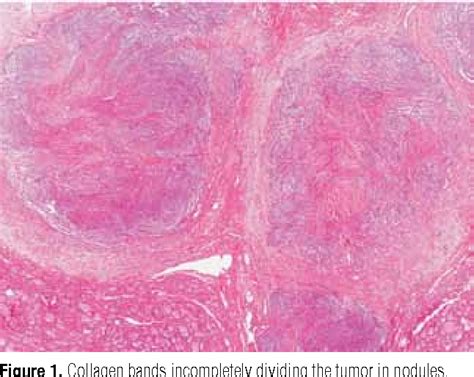 Figure 1 From Thyroid Spindle Epithelial Tumor With Thymus Like