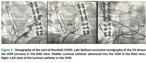 Mitral Isthmus Block By Vein Of Marshall Alcohol Infusion In A Patient