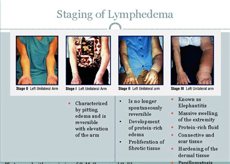 Fig 1 Staging Of Lymphedema Cancer Nurses Lymphedema Mastectomy