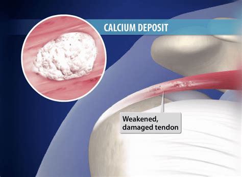Calcific Tendonitis A Painful Shoulder Condition Orthopedic Center
