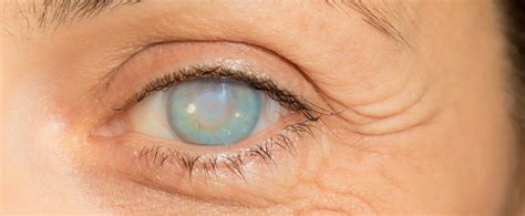 Corneal Blindness Treatment In Delhi Causes Prevention And Cure