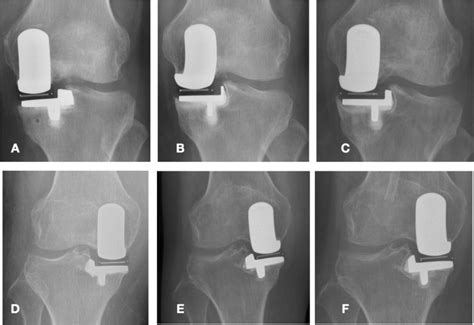 Patient Outcomes In Anteromedial Osteoarthritis Patients Over 80 Years