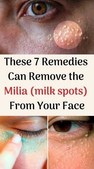 These 7 Remedies Can Remove The Milia Milk Spots From Your Face