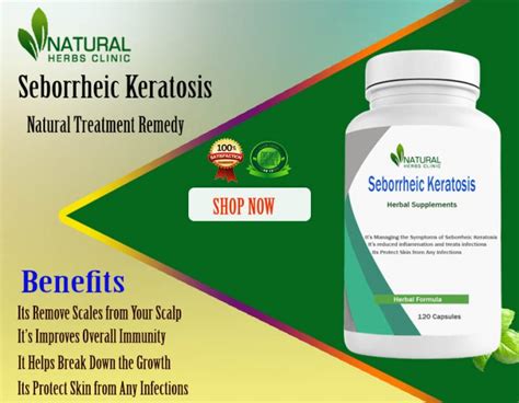 Natural Treatments For Seborrheic Keratosis Ideal Option To Recover It