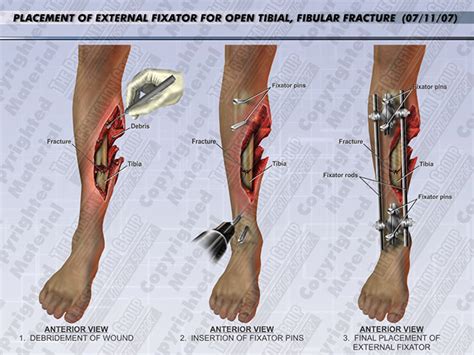 Open Tibia Fracture