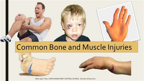 Common Bone And Muscle Injuries
