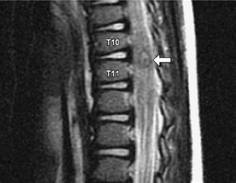 Sagittal T Weighted Mri Of The Thoracic Spine Demonstrating Traumatic Download Scientific