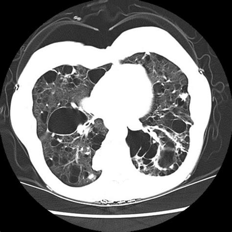 Southwest Journal Of Pulmonary And Critical Care Imaging Medical