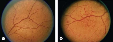 Fluorescein angiographic risk factors for progression of diabetic retinopathy. Diabetic retinopathy grading and classification - EyeSteve.com