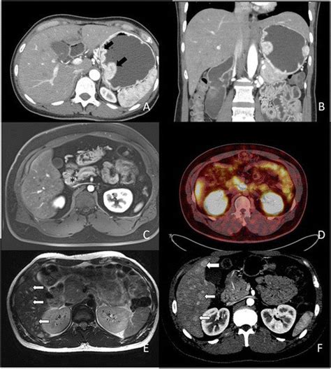 Axial Contrast Enhanced Ct Scan Of Upper Abdomen Arterial Phase Shows