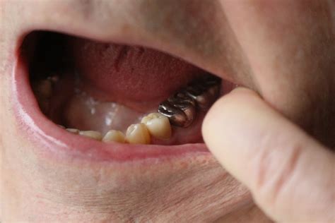 Maybe you would like to learn more about one of these? Bamboozled: What happens to gold teeth when someone is ...
