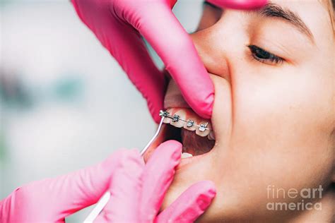 Orthodontist Checking Girl S Braces Photograph By Microgen Images Science Photo Library Fine