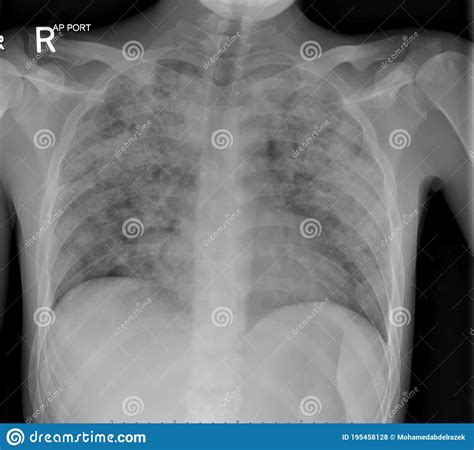 X Ray Of The Chest In A Patient With Active Pulmonary Tuberculosis Tb